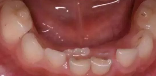 杭州双排牙科普