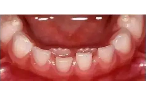 双排牙到底要不要拔？