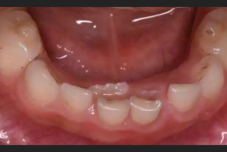 杭口钱晓云，10个孩子里面5个长双排牙