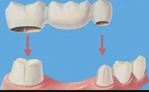 什么是固定义齿、活动义齿、种植义齿？