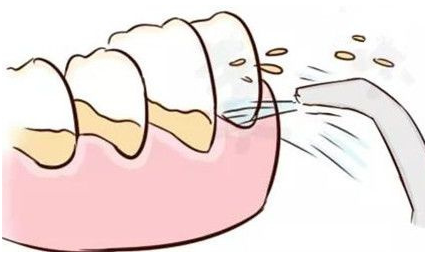 妞爸科普！洗牙到底好不好