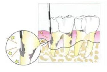 妞爸科普！洗牙到底好不好