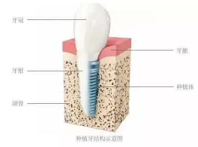 妞爸科普！种植牙到底好不好，好在哪里？