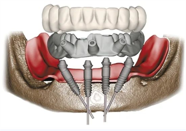 妞爸科普！什么是数字化种植？