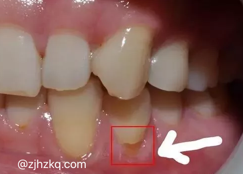 杭州网友，楔状缺损补牙多少钱