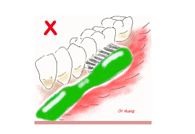 杭州网友，楔状缺损补牙多少钱