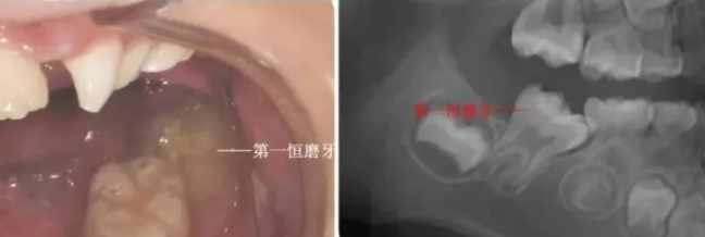 妞爸科普！到底什么是六龄牙？