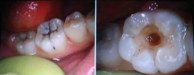 妞爸科普！到底什么是六龄牙？