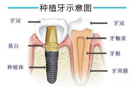 杭州网友，种植牙和假牙的区别是什么？