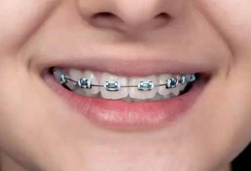 杭州网友，孩子牙齿不齐怎么办？