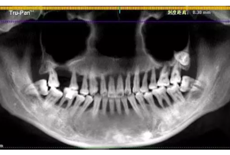 杭州口腔医院看牙记，28岁一排牙被拔光