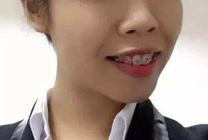 杭州26岁网友，隐适美牙套矫正日记