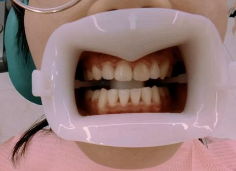 杭州网友，英舒美牙齿美白日记