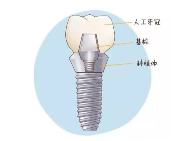 杭州网友，种植牙有哪些好处呢？