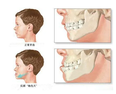 杭州网友，什么是“地包天”?