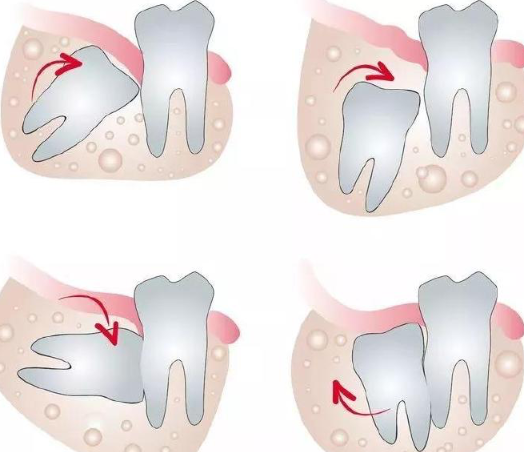 杭州网友，为什么要拔智齿