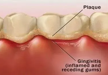杭州网友，怀孕期间的牙周病对孕妇胎儿有什么影响？