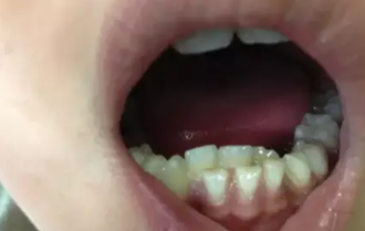 杭州网友，乳牙滞留会造成哪些危害
