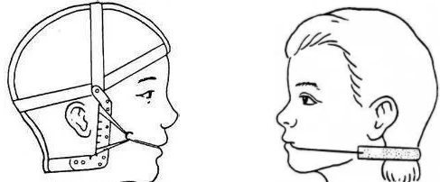 杭州网友，如何佩戴口外弓