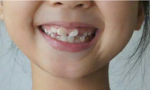 杭州口腔医院庆春分院儿童早期矫正免费招募计划