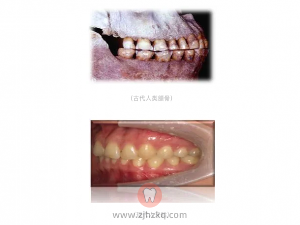 杭州网友，为什么牙齿矫正要拔牙