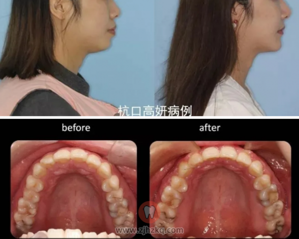 杭州网友，牙齿矫正拔牙一般拔几颗？