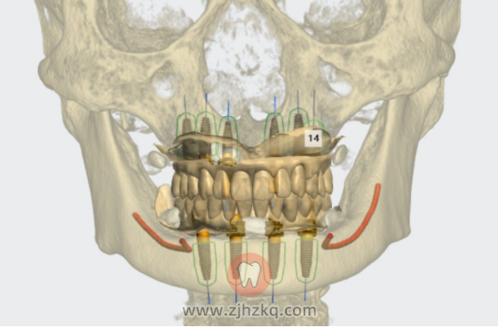 杭州网友，什么是全程数字化微创种植？