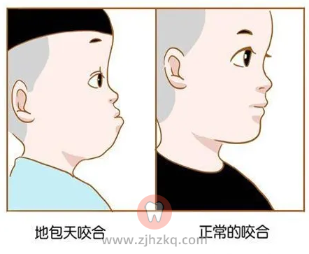 杭州网友，儿童早期矫治一般几岁开始？