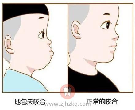 杭州网友，孩子长下巴地包天怎么治疗？多大治疗？