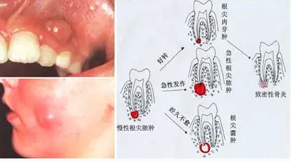 根管治疗杀神经