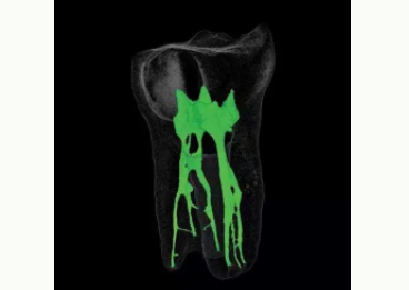 根管治疗杀神经