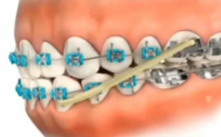 杭州牙齿矫正时间