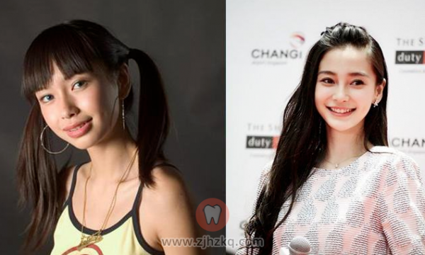 杭州牙齿矫正图片