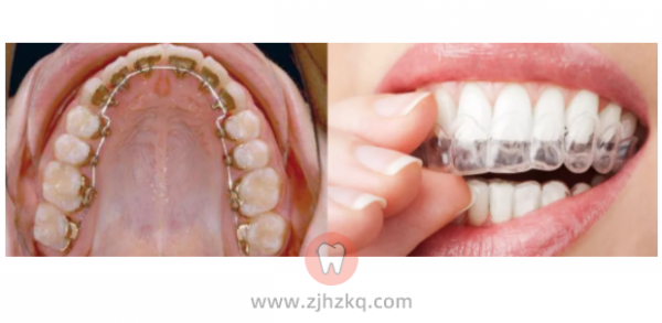 杭州善美口腔暑期正畸牙齿矫正活动0730