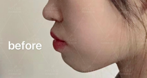 杭州美莱口腔隐适美隐形牙齿矫正日记1220