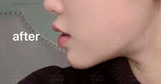 杭州美莱口腔隐适美隐形牙齿矫正日记1220