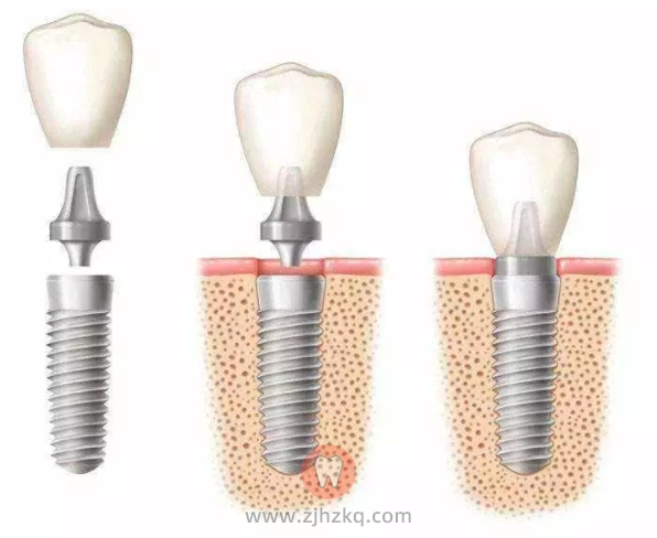 种植牙天然牙区别