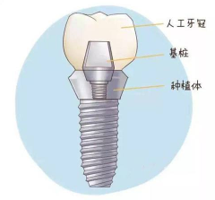 警惕！种植牙有一个致命缺点