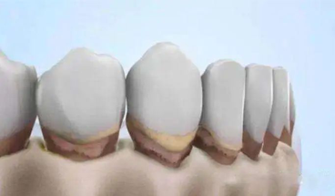 杭州网友，牙龈萎缩是不是不可逆，怎么办？