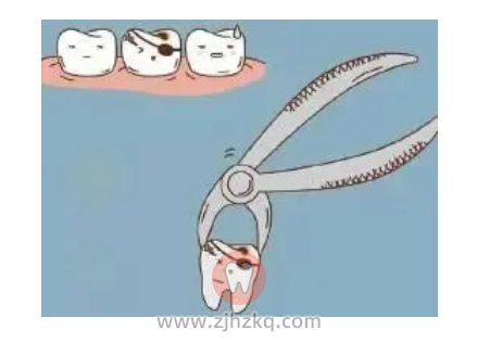 杭州网友杭口拔牙拔智齿日记0517