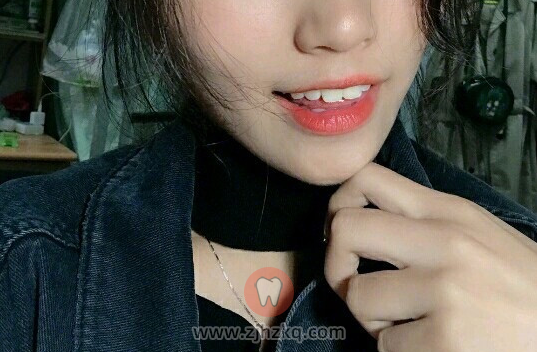 杭州洗牙日记之第一次洗牙