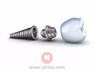 杭州种植牙价格表