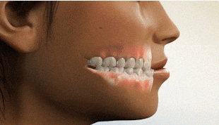 杭州孩子矫正牙齿