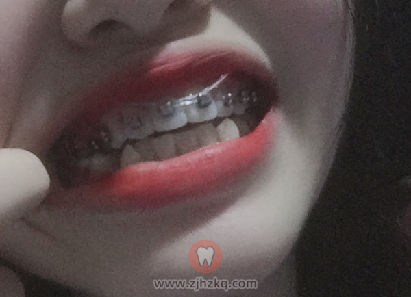 西湖儿童口腔医院金属牙套日记