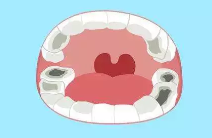 杭州补牙价格多少钱