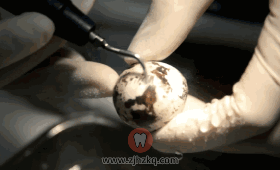 杭州超声波洗牙危害