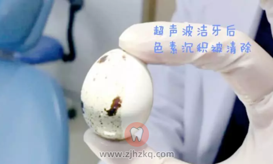 杭州超声波洗牙危害