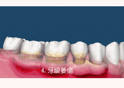 杭州洗牙不好