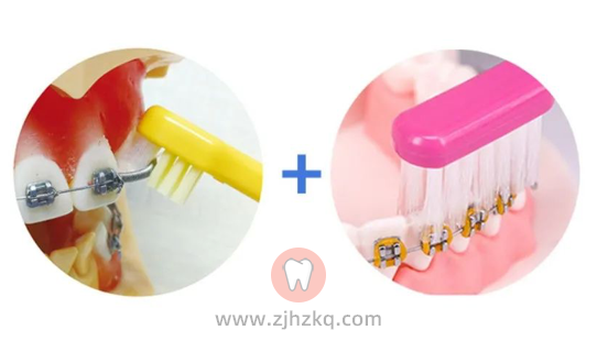 杭州网友，牙齿矫正期间如何正确刷牙？