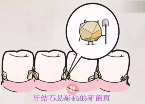 杭州牙结石